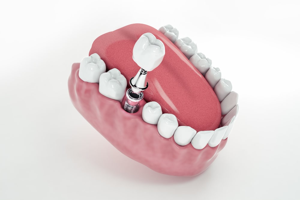 implant diş ölçüsü alındıktan sonra nelere dikkat edilmeli