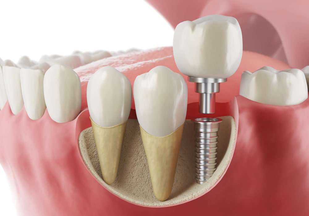 implant diş takılırken dikkat edilmesi gerekenler